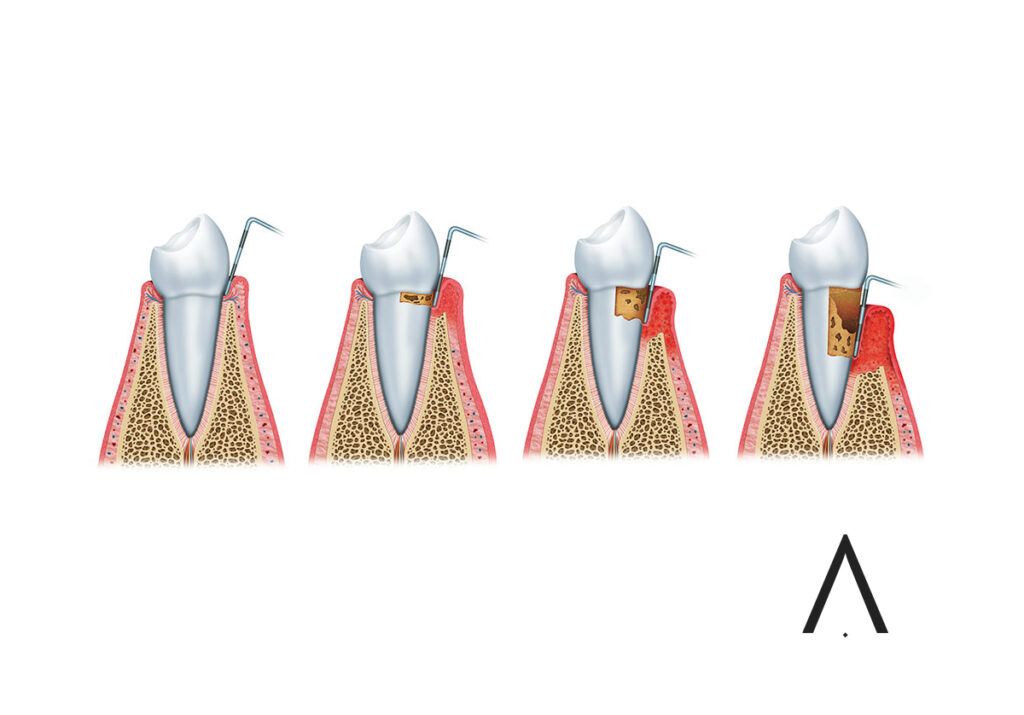 periodontitis alumamedicalart web