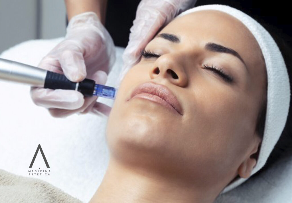 microneedling
