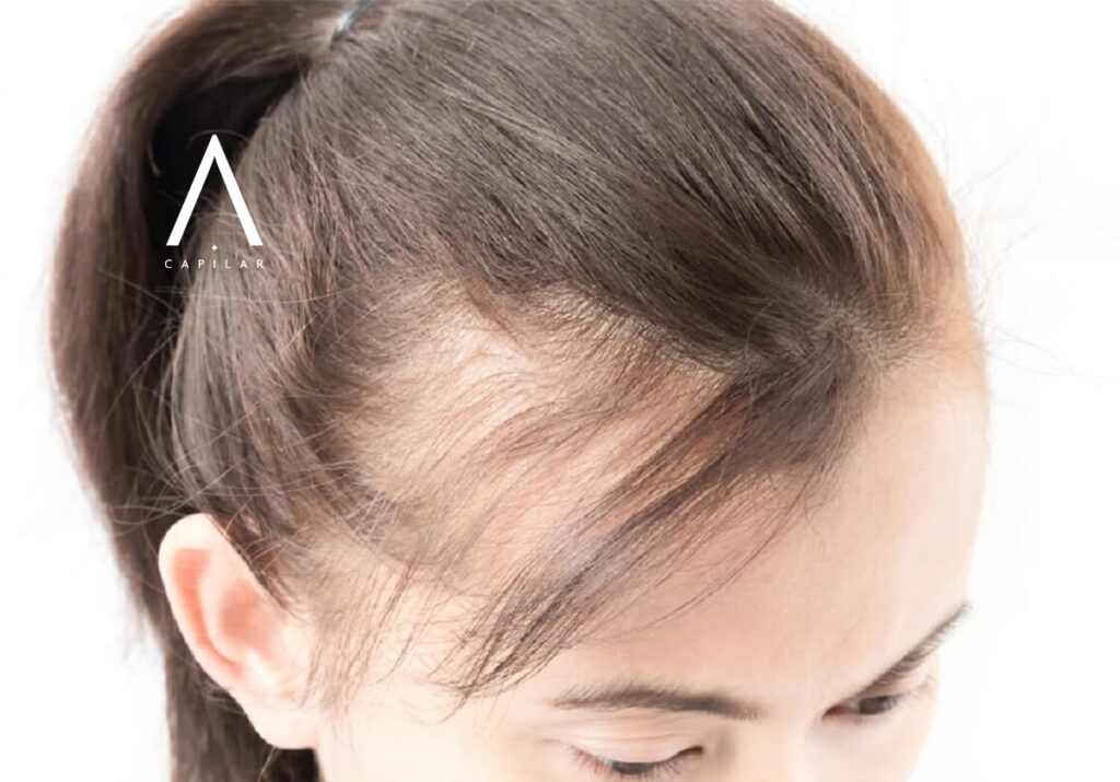 alopecia androgénica