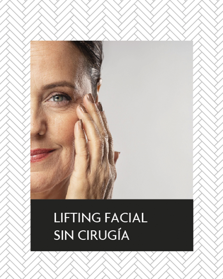 Lifting facial sin cirugía Radiesse