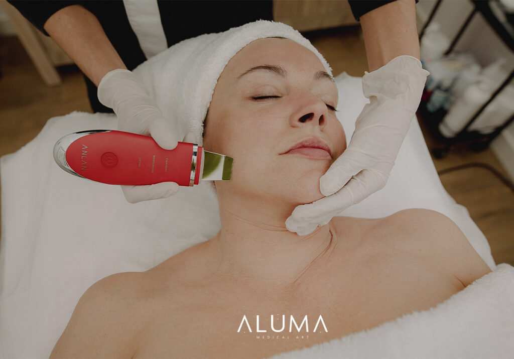 cómo tratar el acné adulto