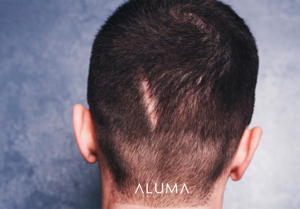 alopeciacicatricial alumamedicalart web