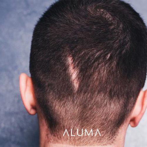 alopeciacicatricial alumamedicalart web