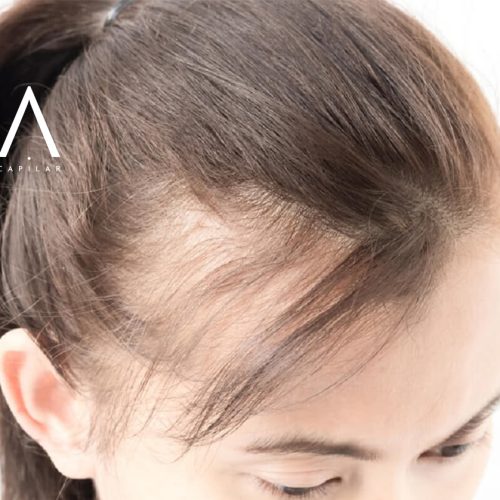 alopecia androgénica