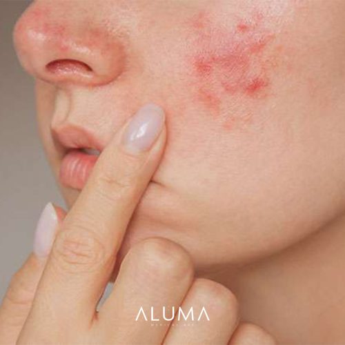 alumamedicalart rosácea web