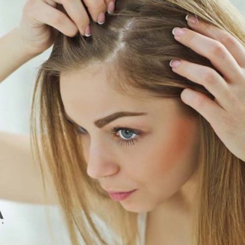 caída capilar reaccional