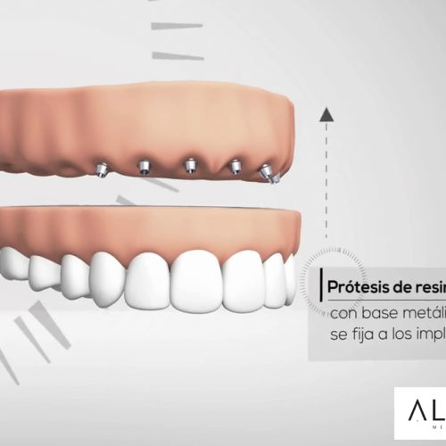 implantologíacargainmediata alumamedicalart