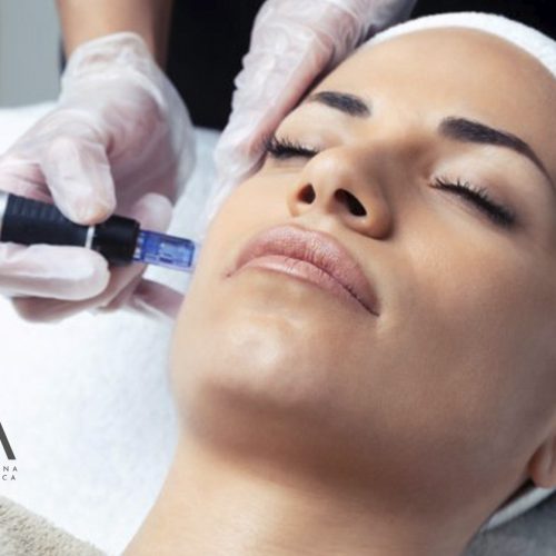microneedling