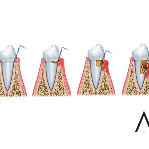periodontitis alumamedicalart web